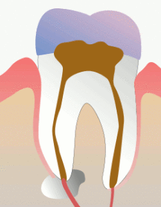 root canal procedure done